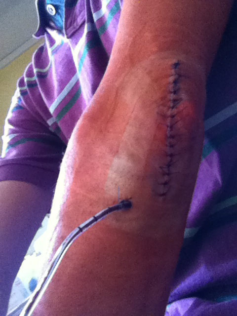 Arm mit Trinkhalm.